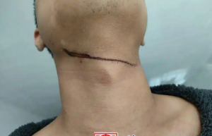 男子夜晚騎車回小區(qū)遭晾衣繩割喉 物業(yè)回應尚未找到拴繩人